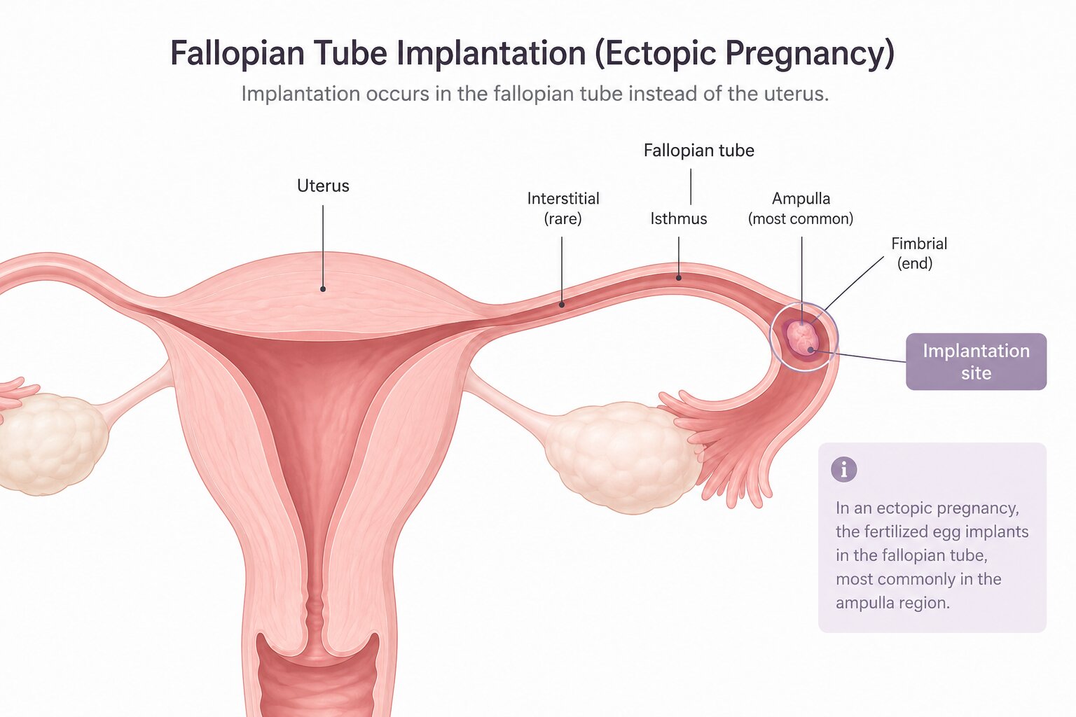 Diagram showing where an ectopic pregnancy implants in the fallopian tube